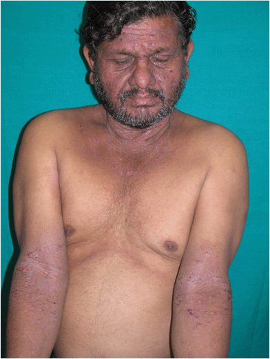Parthenium dermatitis – airborne contact dermatitis pattern (ABCD). Note the diffuse involvement of the face including eyelids, neck, V of chest, cubital fossa with erythema, erosion, oozing and crusting.