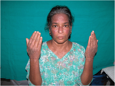 Parthenium dermatitis – chronic actinic dermatitis (CAD) in a female. Note the lichenified papuloplaques over the dorsum of hands, forehead and cheeks.