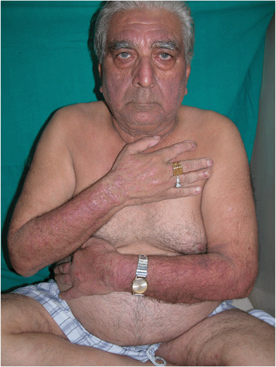 Parthenium dermatitis – elderly male with chronic actinic dermatitis (CAD)-like pattern. Note the lichenified plaques over the dorsum of hands, extensors of forearms, forehead and cheeks.