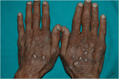 Parthenium dermatitis – prurigo nodularis-like pattern. Note multiple hyperkeratotic prurigo like papules and nodules over the dorsum of hands.