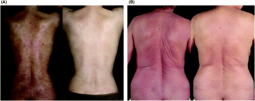 Clinical treatment effect of extracorporeal photochemotherapy in patients with severe atopic dermatitis. (A) 30 year old woman (patient no. 7) with chronic poikilodermic atopic dermatitis before (left photograph) and after 18 weeks of ECP (right photograph). (B) 59 year old woman (patient no. 6) with erythrodermic atopic dermatitis before (left photograph) and 24 weeks after start of ECP (right photograph). Note in both patients a significant improvement of skin lesions was observed after ECP.