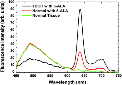 Fluorescence intensity spectra illustrating the differences in PpIX fluorescence, from a sBCC lesion (-) and surrounding normal skin tissue () 6 h after ALA application. Normal skin tissue that has not been incubated with ALA is also shown (). Reduced autofluorescence from the lesion (-) is typical when compared to the surrounding normal skin tissue.31