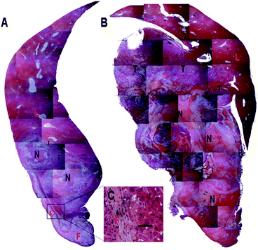 Histopathological observation of liver samples in 6% Dox fibers group (A) and control group (B) on the 30th day after tumor inoculation. F = Dox fibers; L = liver; N = necrosis or degeneration; T = viable tumor tissue. The selected area in A is shown in images C in a high magnification (bar = 50 μm).