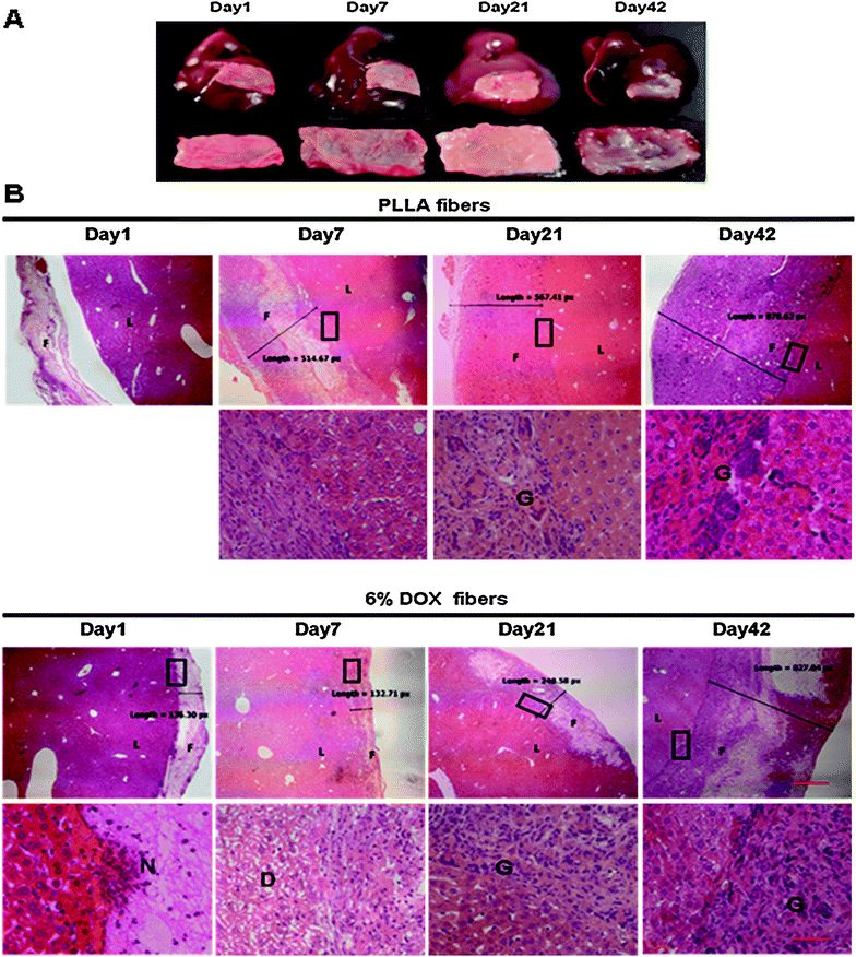 Local liver tissue response to 6% Dox fibers. (A) Photographs of the excised livers with adhered 6% Dox fibers (the upper panel) and the fiber-mats separated from the liver (the lower panel). (B) Micrographs of the borderline between fiber-mat and liver tissue. F = fibers; L = liver; N = neutrophil; G = giant cells; D = degeneration; the bar is 500 μm in the upper panel and 50 μm in the lower panel. The boundary areas in the rectangles are enlarged to form the lower panel images.