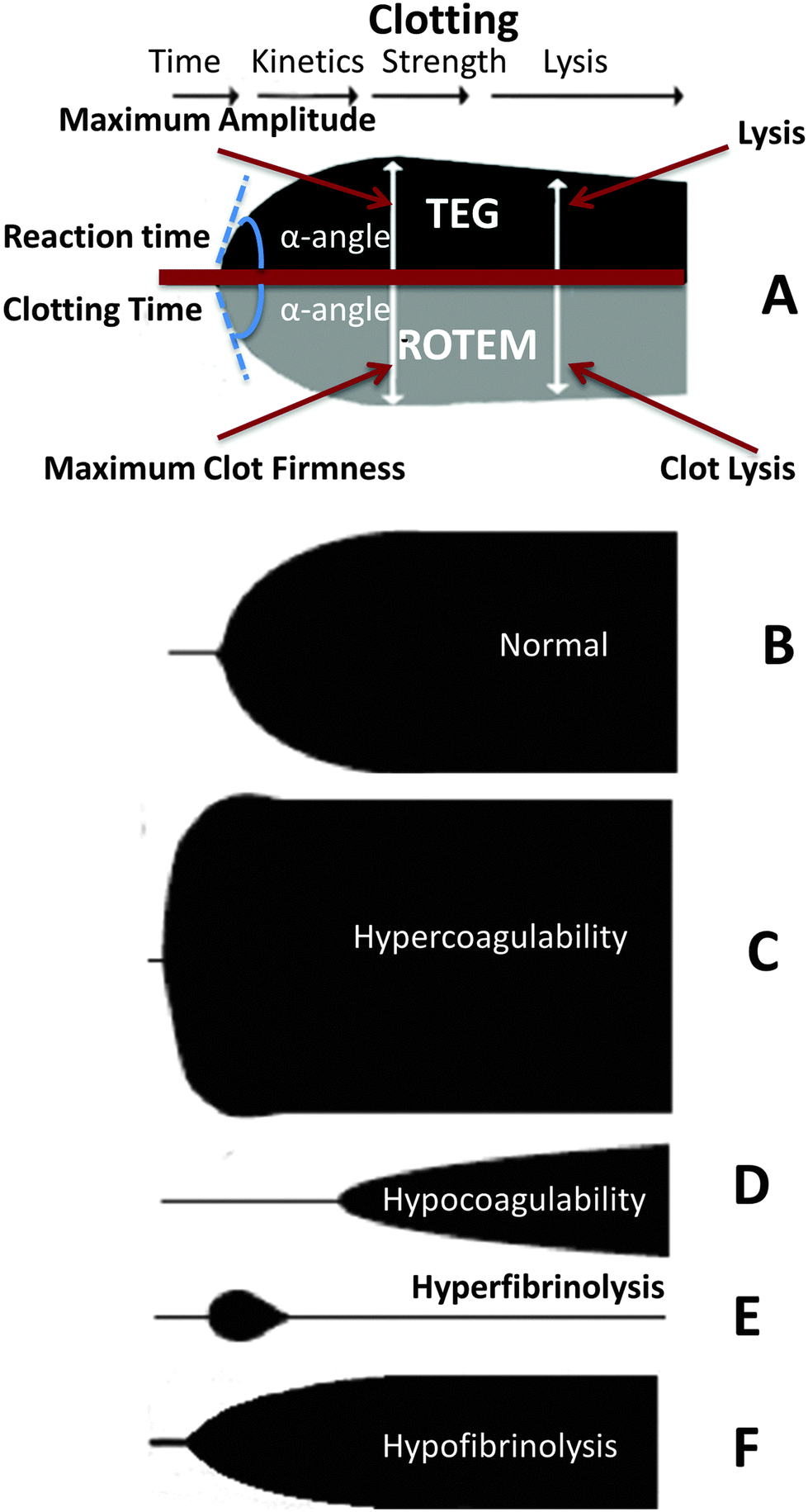 The simultaneous occurrence of both hypercoagulability and 