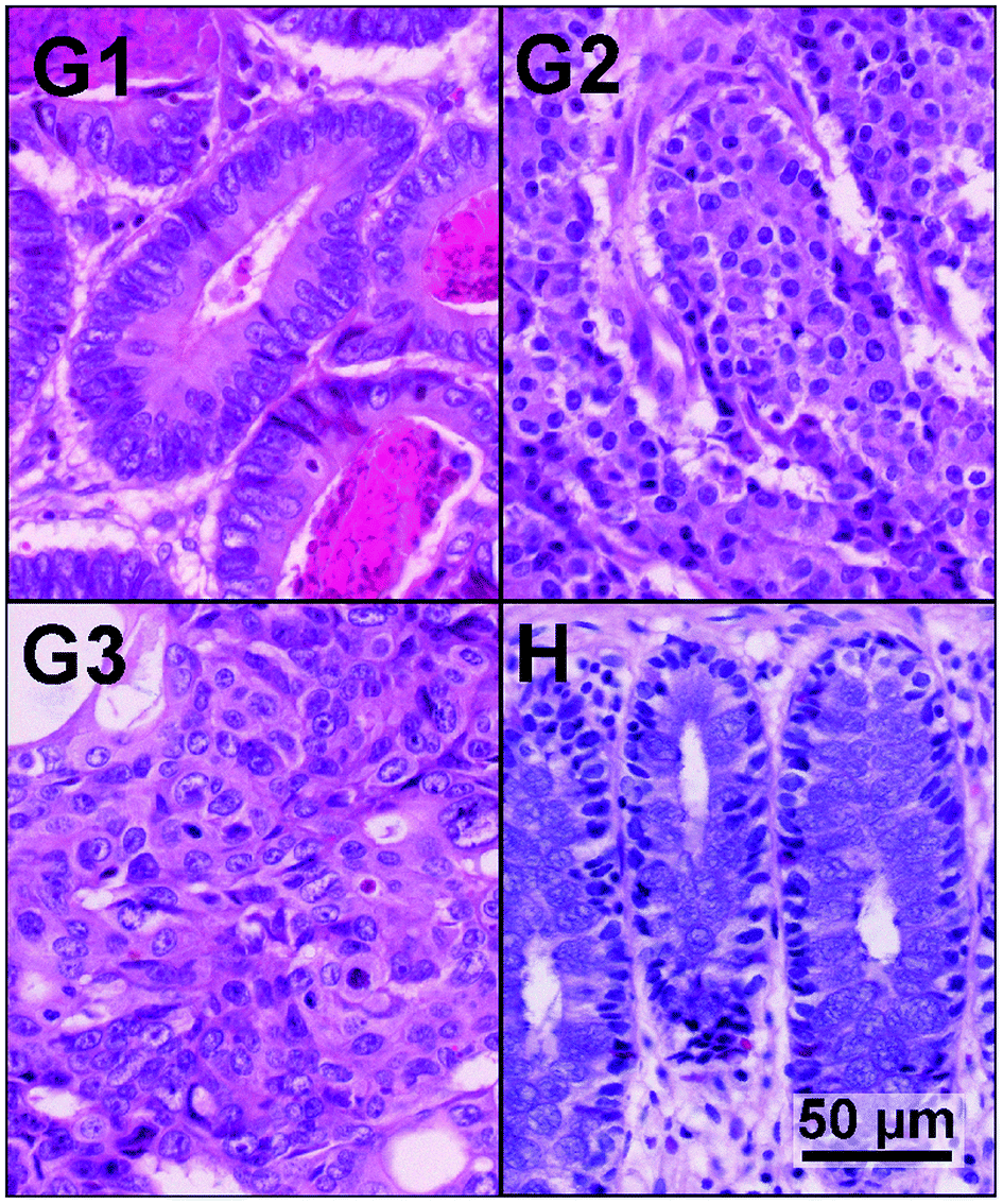 Cancer colon g2, ATLAS DE MORFOPATOLOGIE