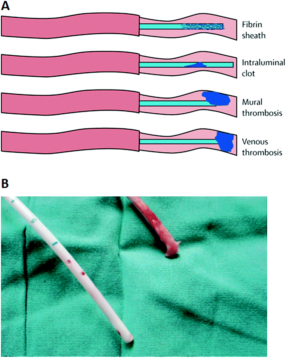 Surface modification strategies for combating catheterrelated