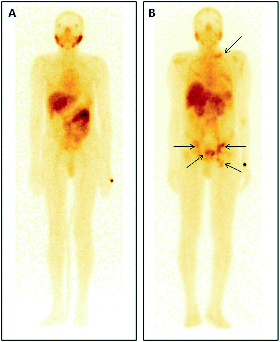carcinoma della prostata 5 percento