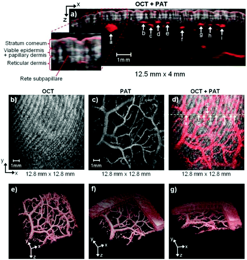 Retinal vascular assessment in psoriatic patients with and without  metabolic syndrome using optical coherence tomography angiography