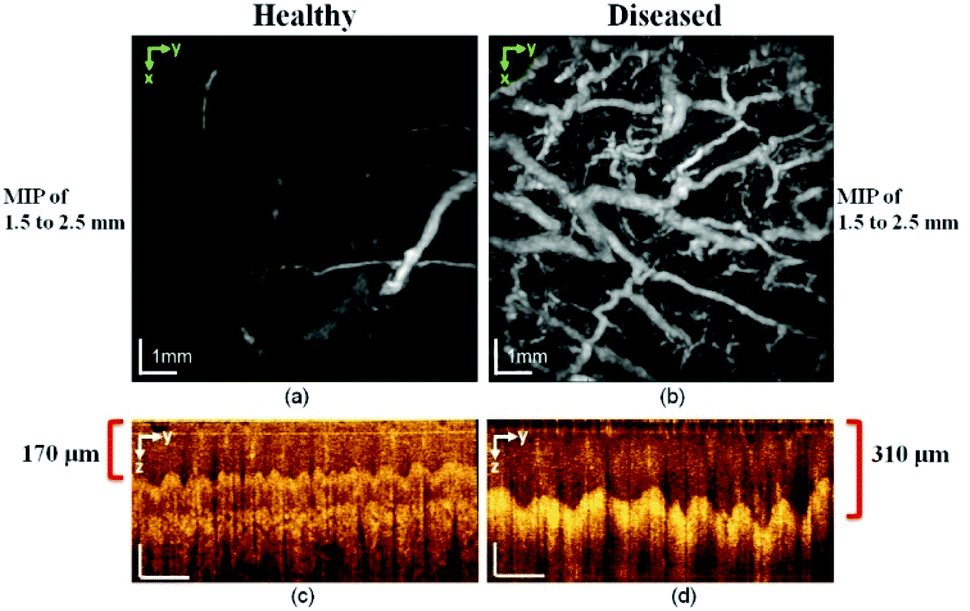 Retinal vascular assessment in psoriatic patients with and without  metabolic syndrome using optical coherence tomography angiography