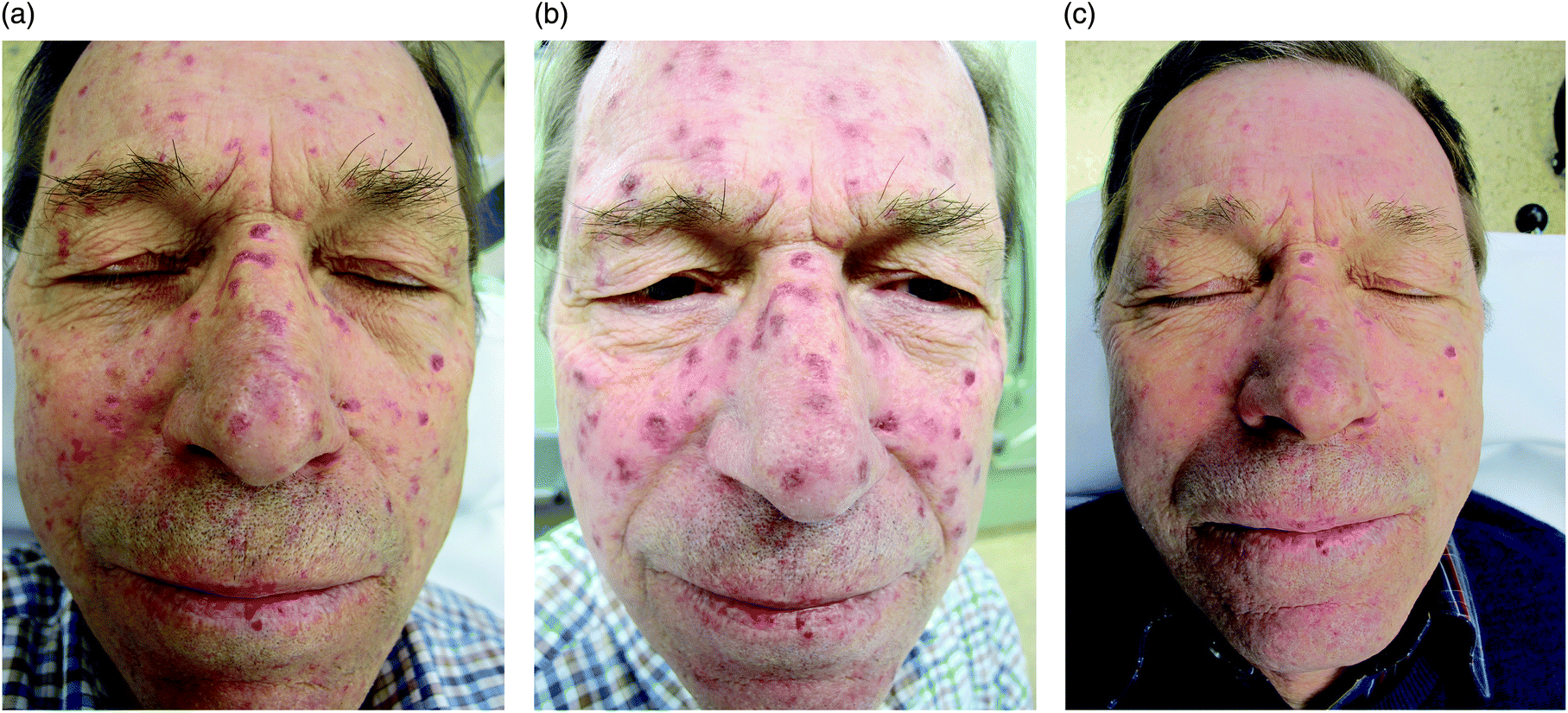 Laser treatment of vascular dermatological diseases using a pulsed dye  laser (595 nm) in combination with a Neodym:YAG-laser (1064 nm) -  Photochemical & Photobiological Sciences (RSC Publishing)  DOI:10.1039/C9PP00079H