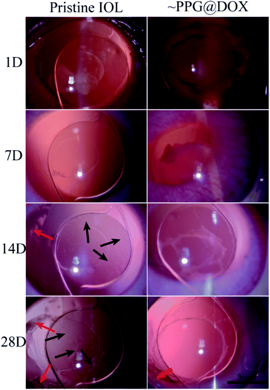 Drug-eluting intraocular lens with sustained bromfenac release for  conquering posterior capsular opacification - ScienceDirect