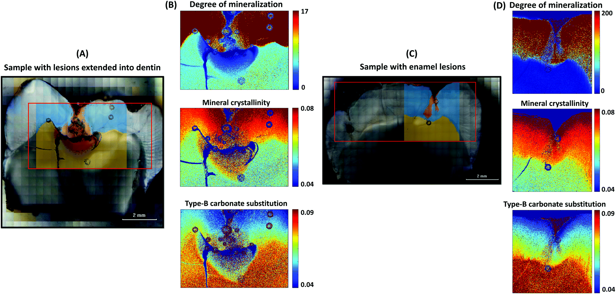 Mineralization of dental tissues and caries lesions detailed with Raman ...