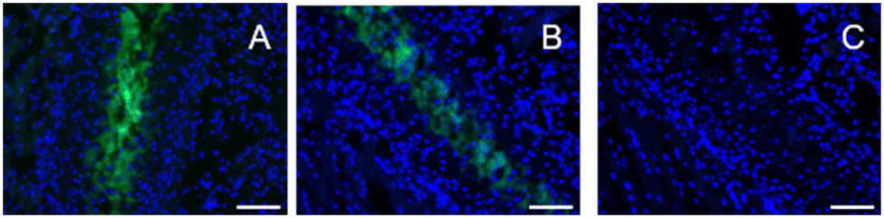 Association of Microcalcification Clusters with Short-term Invasive Breast  Cancer Risk and Breast Cancer Risk Factors