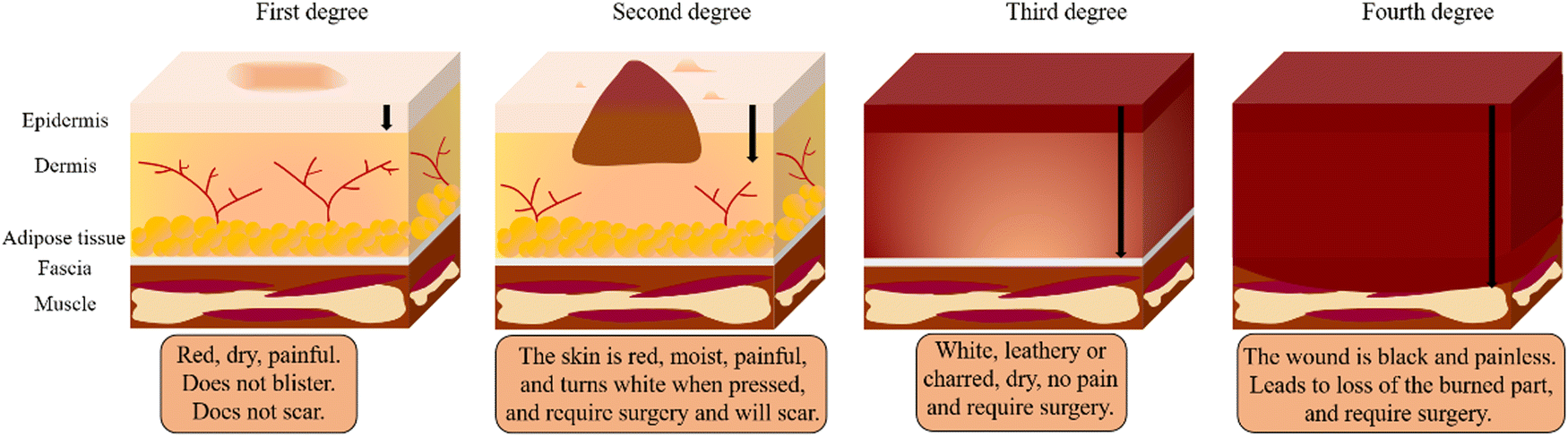 Fourth Degree Burn Diagram