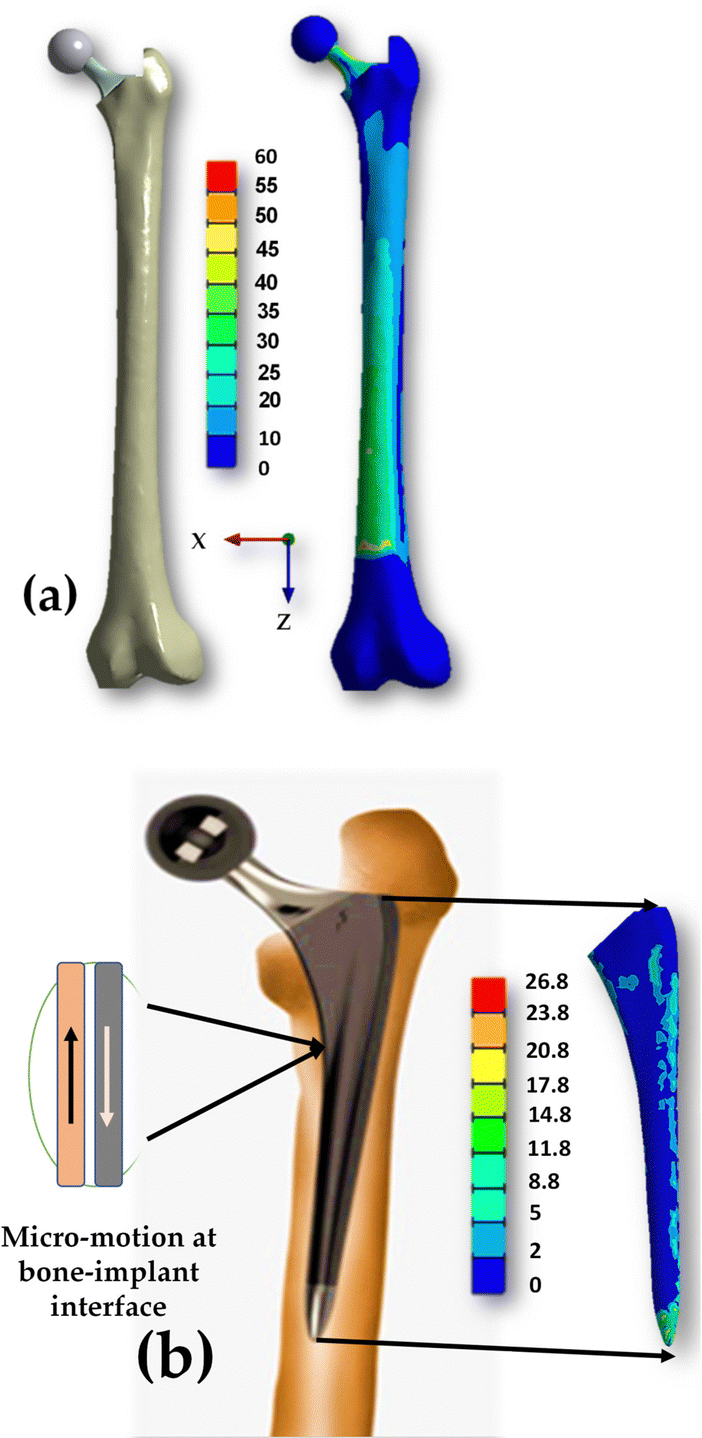 Biomechanical comparison of different prosthetic materials and posterior  implant angles in all-on-4 treatment concept by three-dimensional finite  element analysis