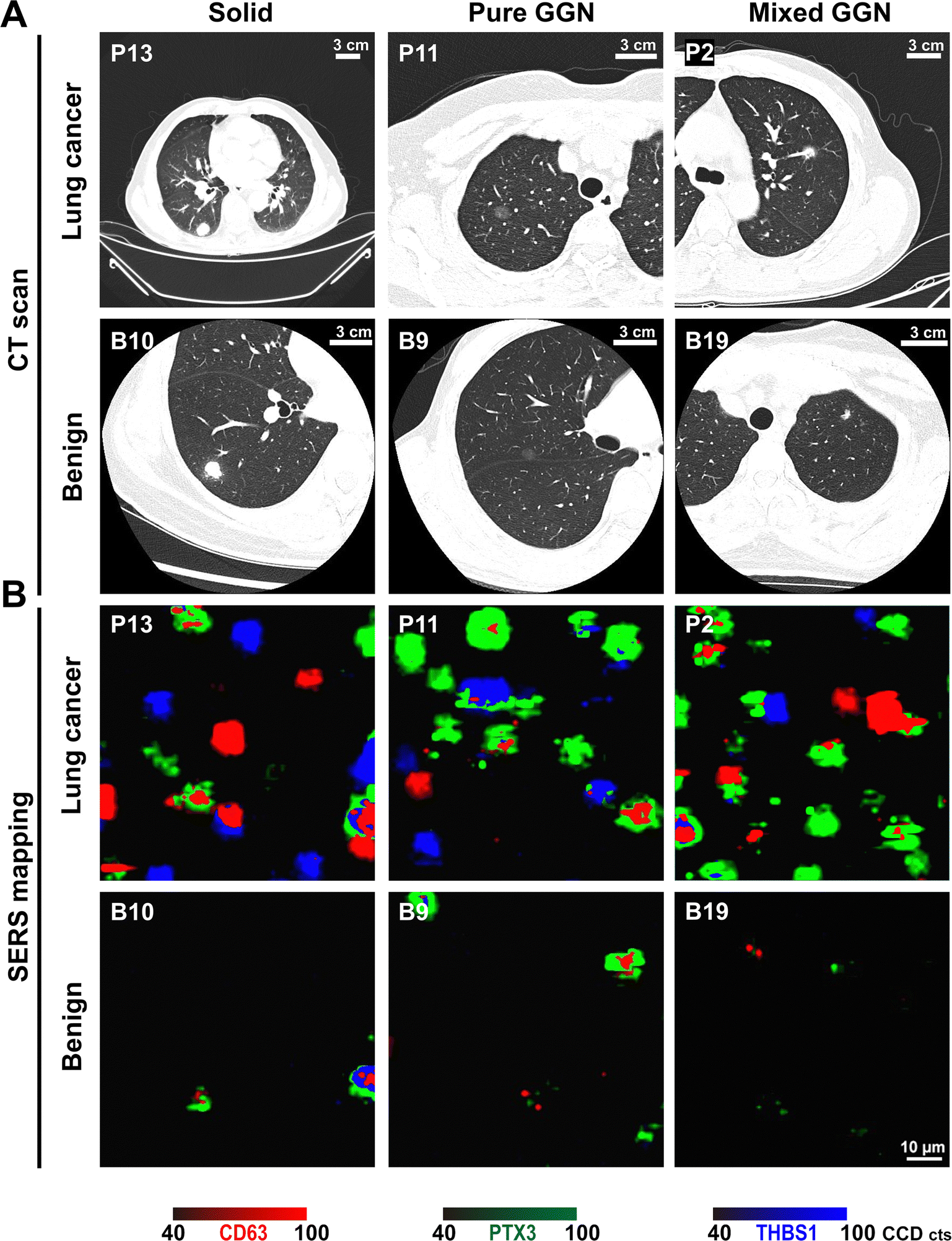 Plasma Extracellular Vesicle Phenotyping For The Differentiation Of ...