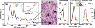 Graphical abstract: Prediction potential of IR-micro spectroscopy for colon cancer relapse