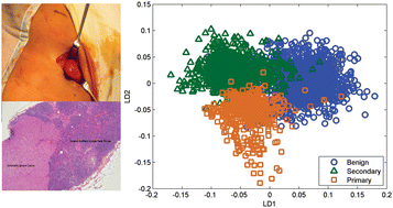 Graphical abstract: Discrimination between benign, primary and secondary malignancies in lymph nodes from the head and neck utilising Raman spectroscopy and multivariate analysis