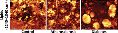 Graphical abstract: Pathological changes in the biochemical profile of the liver in atherosclerosis and diabetes assessed by Raman spectroscopy