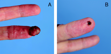 Graphical abstract: A potassium-titanyl-phosphate laser is an efficacious tool in the treatment of pyogenic granulomas. A retrospective study in 28 patients