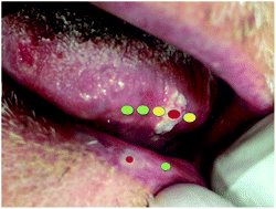 Graphical abstract: New insights of Raman spectroscopy for oral clinical applications