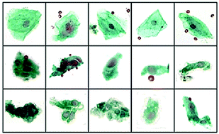 Graphical abstract: Can mid-infrared biomedical spectroscopy of cells, fluids and tissue aid improvements in cancer survival? A patient paradigm