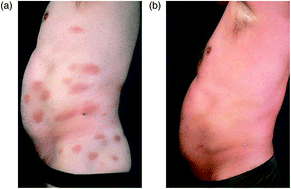 Graphical abstract: Phototherapy of cutaneous T-cell lymphomas