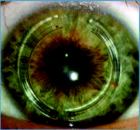 Graphical abstract: Femtosecond laser in refractive corneal surgery