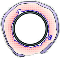 Graphical abstract: Engineering an immunomodulatory drug-eluting stent to treat laryngotracheal stenosis