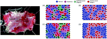 Graphical abstract: Diagnosis of early-stage esophageal cancer by Raman spectroscopy and chemometric techniques