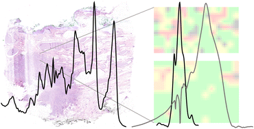 Graphical abstract: Breast cancer or surrounding normal tissue? A successful discrimination by FTIR or Raman microspectroscopy