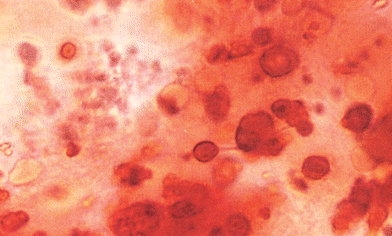 A synovial fluid wet smear stained with Alizarin red S. The darker red deposits have the appearance of hydroxyapatitc accumulations. The specimen is from a patient with end-stage renal disease (magnification × 720, original magnification × 200). Reproduced with permission from ref. 94. (Copyright 1992, Ciba-Geigy Corp.)