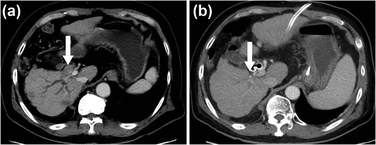 Graphical abstract: Photodynamic therapy for bile duct invasion of hepatocellular carcinoma