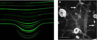 Graphical abstract: Non-dimensional analysis of retinal microaneurysms: critical threshold for treatment