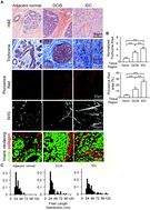 Graphical abstract: Human breast cancer invasion and aggression correlates with ECM stiffening and immune cell infiltration