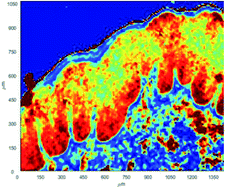 Graphical abstract: Identification of cancer associated molecular changes in histologically benign vulval disease found in association with vulval squamous cell carcinoma using Fourier transform infrared spectroscopy