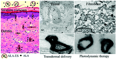 Graphical abstract: 5-Aminolevulinic acid loaded ethosomal vesicles with high entrapment efficiency for in vitro topical transdermal delivery and photodynamic therapy of hypertrophic scars