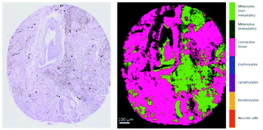 Graphical abstract: Infrared imaging of primary melanomas reveals hints of regional and distant metastases