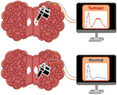 Graphical abstract: High wavenumber Raman spectroscopy for intraoperative assessment of breast tumour margins