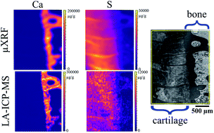 Graphical abstract: Correlation of μXRF and LA-ICP-MS in the analysis of a human bone-cartilage sample